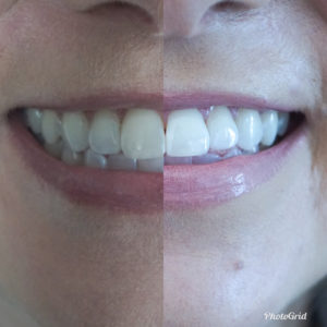before and after