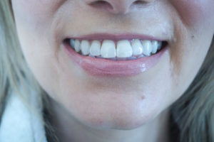 teeth after